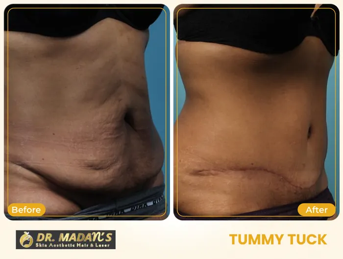 Tummy tuck before and after result 4 at Dr Madan Aesthetics